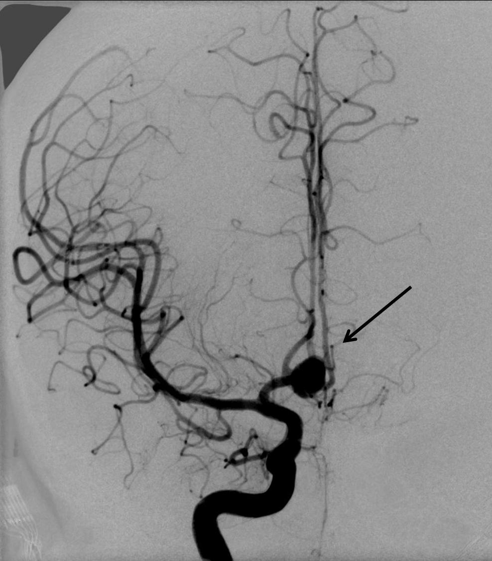 Aneurisma Cerebral 1