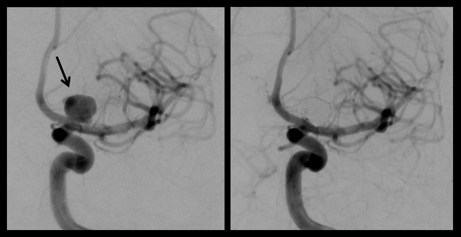 Aneurisma Cerebral 1