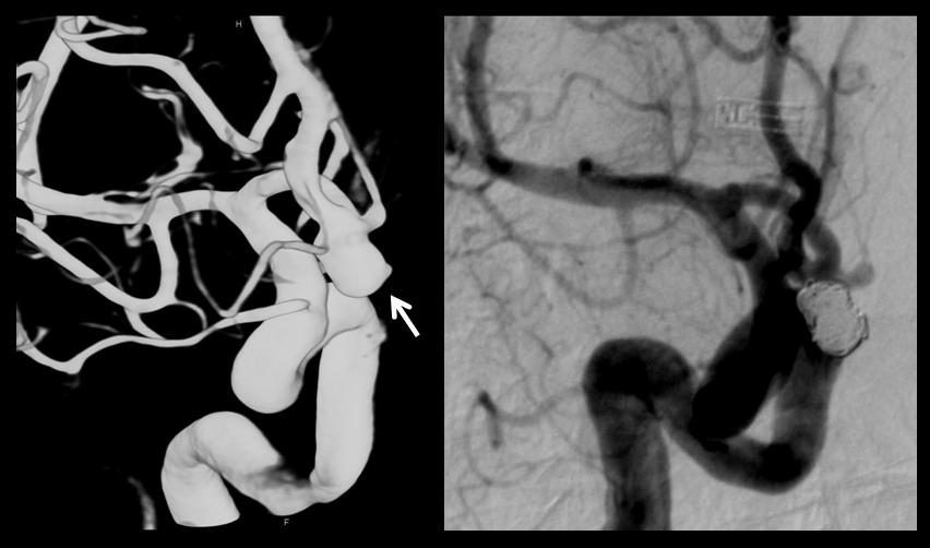 Aneurisma Cerebral 1