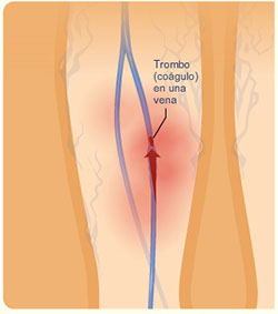 coagulo en la pierna
