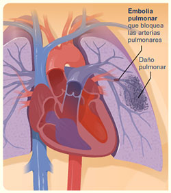 embolia pulmonar