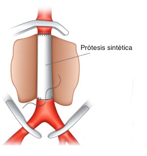 aneurisma aorta abdominal 3