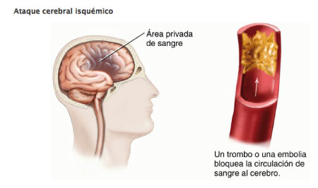 Resultado de imagen de ait isquemic