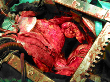 Imagen intra-operatoria de una cirugía de la aorta torácica descendente