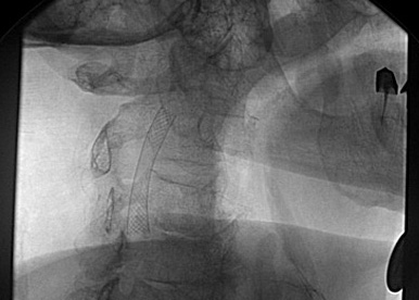 implante stent carotida