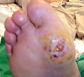 Imagen de úlcera de pie diabético