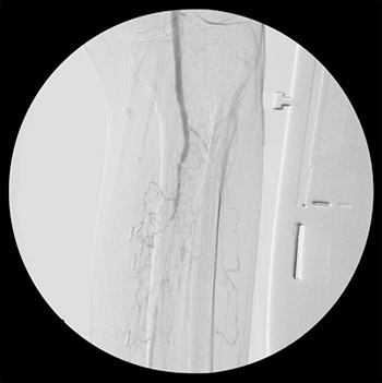 Arteriografía pre-tratamiento endovascular