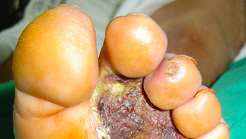 Imagen de úlcera de pie diabético 