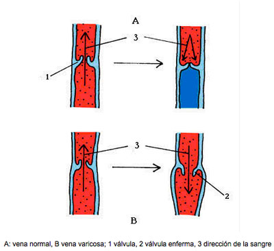 varices2