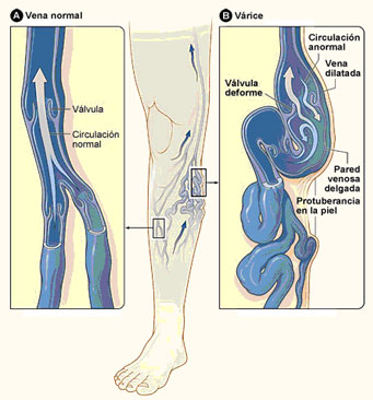 varices3