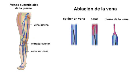 varices9